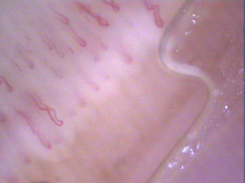 Image of capillaries